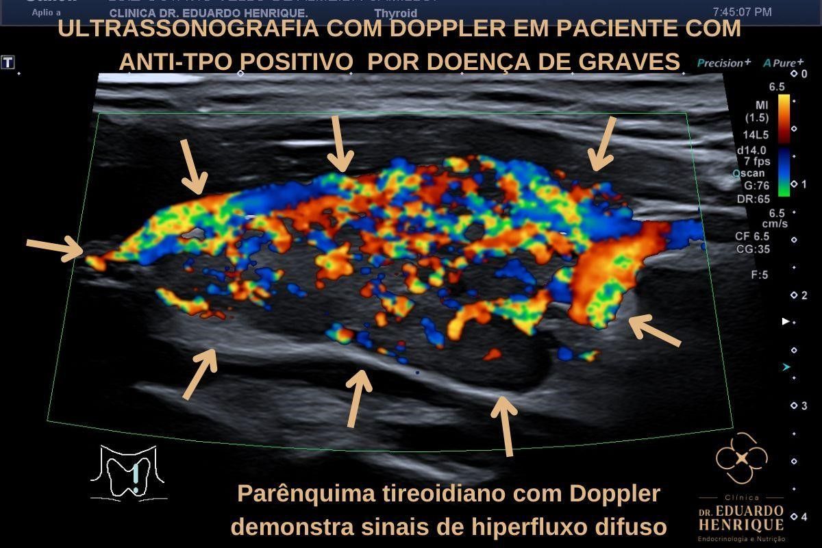 doenca-de-graves-dr-eduardo-henrique-endocrinologista-sao-paulo
