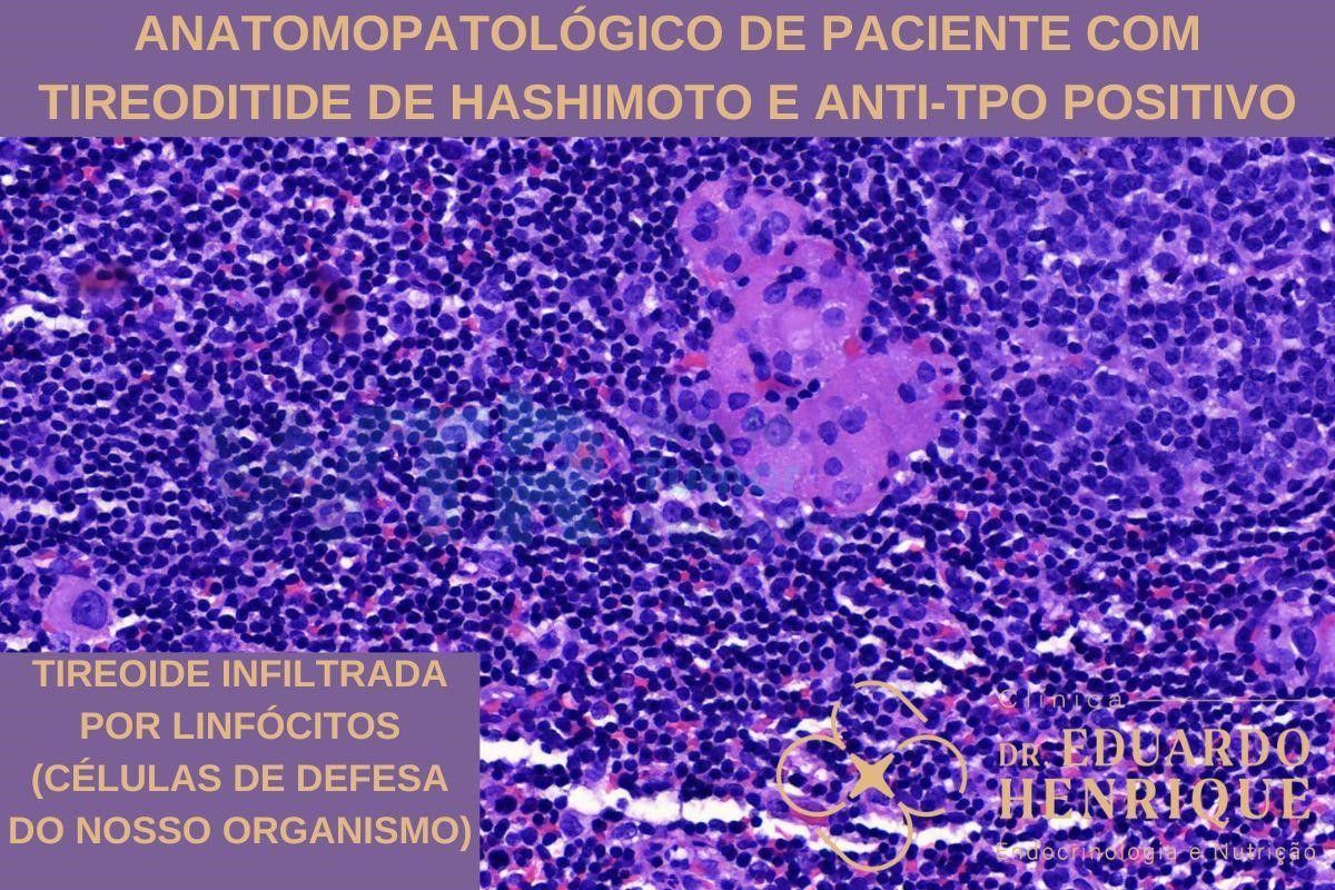 exame-anticorpos-antiperoxidase-dr-eduardo-henrique-endocrinologista-sao-paulo