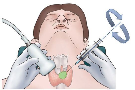 Punção Nódulo Tireoide PAAF Guiada Ultrassom São Paulo