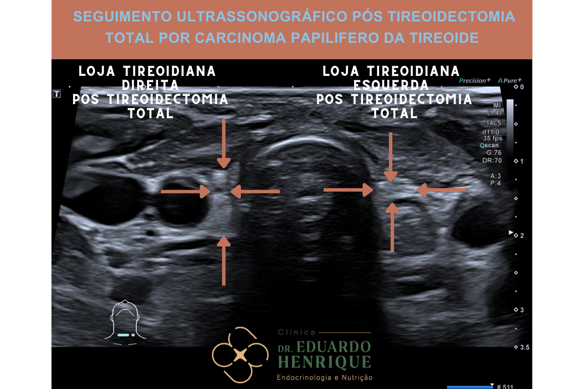 Seguimento do Paciente Pós Tireoidectomia uma Abordagem Integral