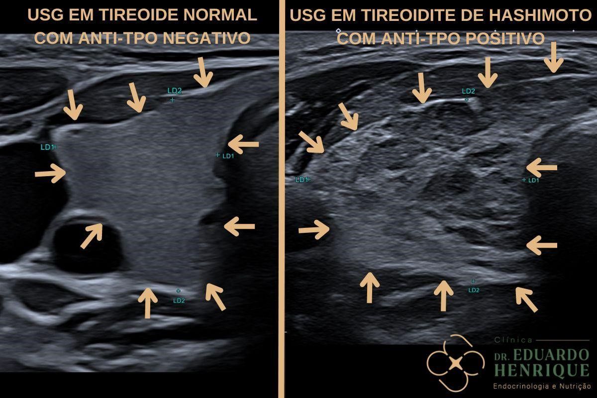 usg-tireoide-normal-dr-eduardo-henrique-endocrinologista-sao-paulo
