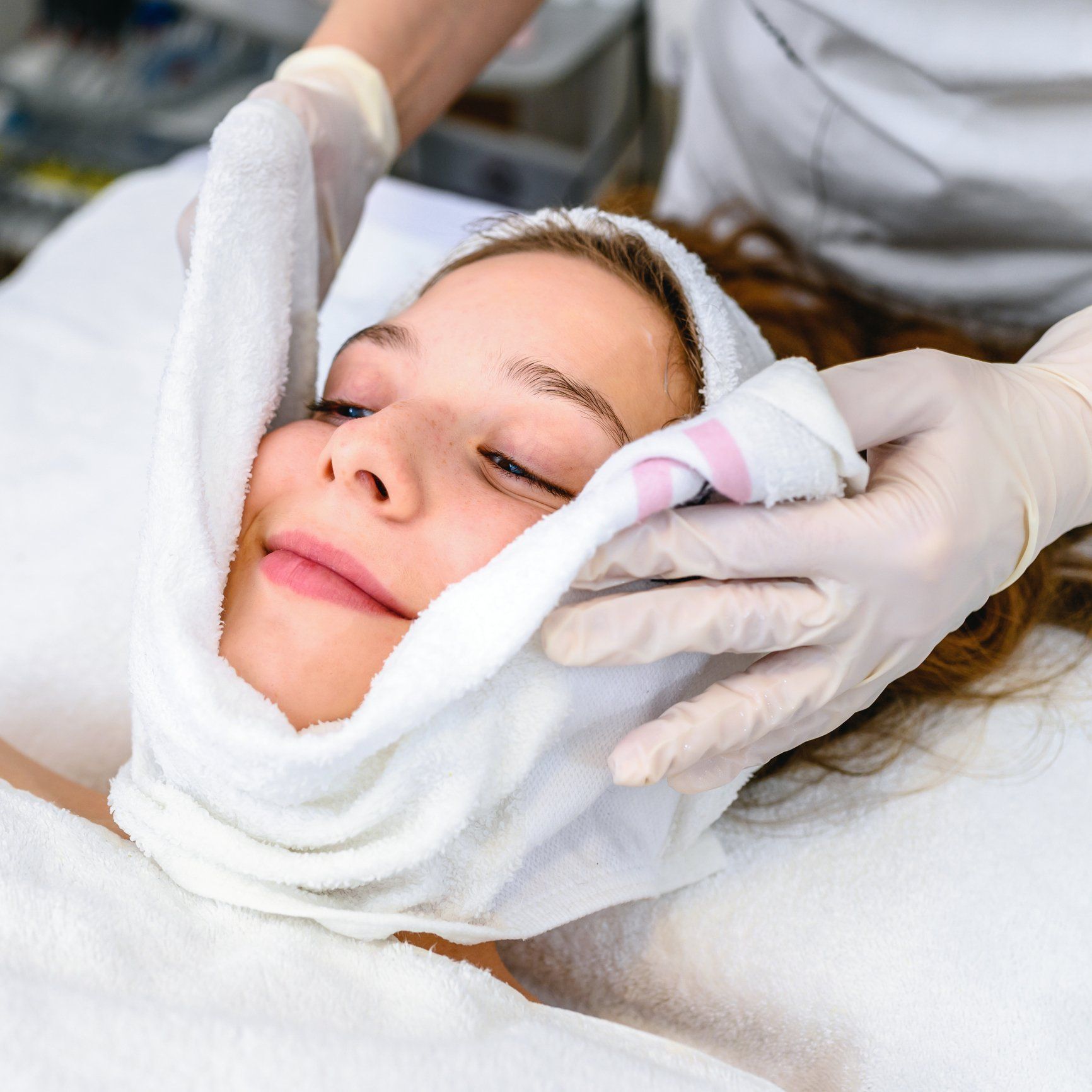 Acne Facial