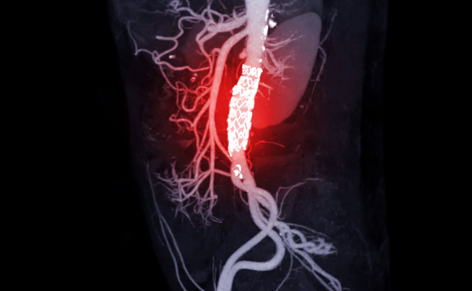 Abdominal Aortic Aneurysm — Tuscon, AZ — Arizona EndoVascular Center