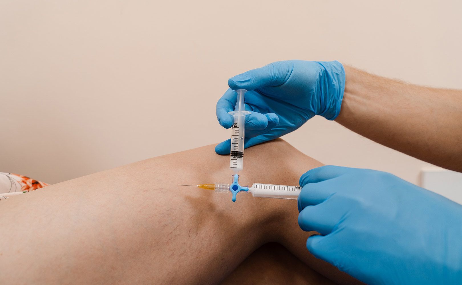 Sclerotherapy — Tuscon, AZ — Arizona EndoVascular Center