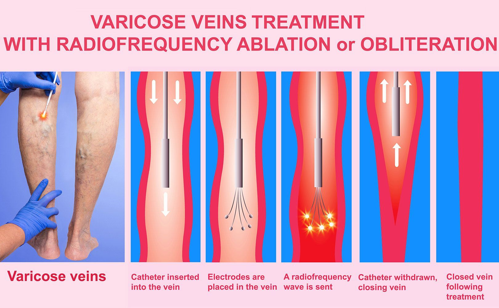 Radiofrequency Ablation — Tuscon, AZ — Arizona EndoVascular Center