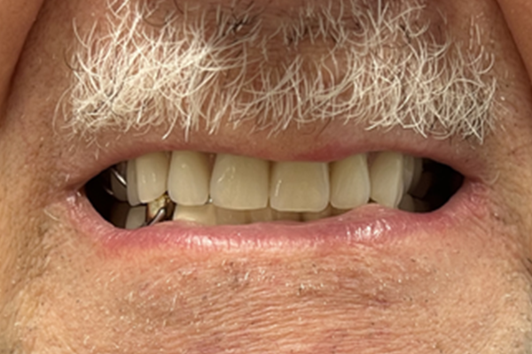 a close up of a person 's mouth with white teeth | Before and After Denture Treatment | Envision Denture and Implant Centre | Best Denturist In Surrey, British Columbia