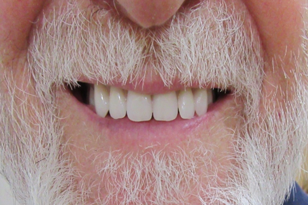 a close up of a person 's mouth with white teeth and red lips | Before and After Denture Treatment | Envision Denture and Implant Centre | Best Denturist In Surrey, British Columbia