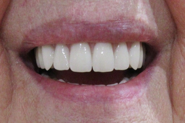 a close up of a man 's mouth with a beard and white teeth | Before and After Denture Treatment | Envision Denture and Implant Centre | Best Denturist In Surrey, British Columbia