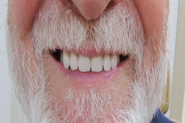 a close up of a person 's mouth with white teeth and red lips | Before and After Denture Treatment | Envision Denture and Implant Centre | Best Denturist In Surrey, British Columbia