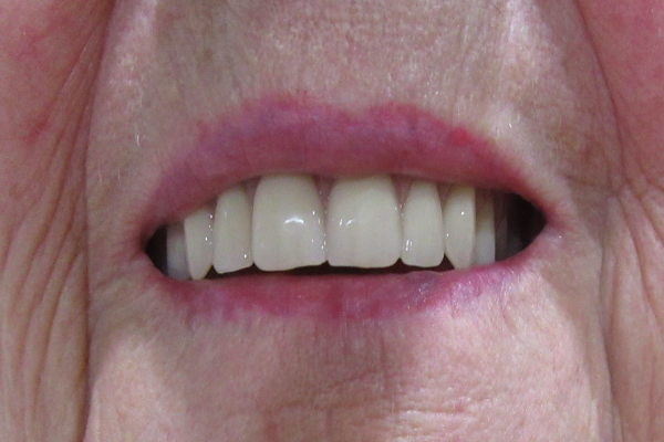 a close up of a person 's mouth with white teeth | Before and After Denture Treatment | Envision Denture and Implant Centre | Best Denturist In Surrey, British Columbia