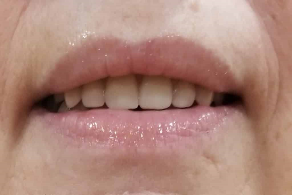 a close up of a man 's mouth with white teeth | Before and After Denture Treatment | Envision Denture and Implant Centre | Best Denturist In Surrey, British Columbia