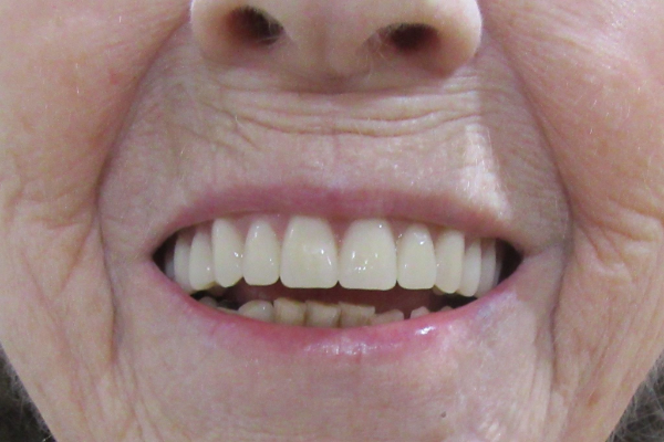 a close up of a person 's mouth with white teeth | Before and After Denture Treatment | Envision Denture and Implant Centre | Best Denturist In Surrey, British Columbia