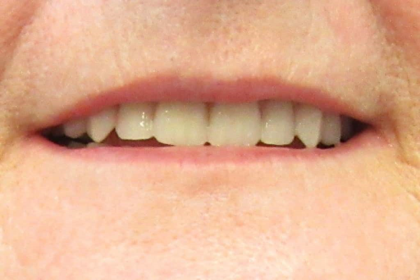 a close up of a man 's mouth with white teeth | Before and After Denture Treatment | Envision Denture and Implant Centre | Best Denturist In Surrey, British Columbia