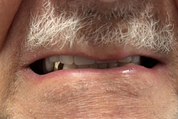 a close up of a person 's mouth with white teeth | Before and After Denture Treatment | Envision Denture and Implant Centre | Best Denturist In Surrey, British Columbia