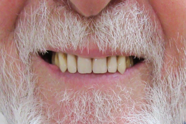 a close up of a woman 's mouth with white teeth and pink lipstick | Before and After Denture Treatment | Envision Denture and Implant Centre | Best Denturist In Surrey, British Columbia