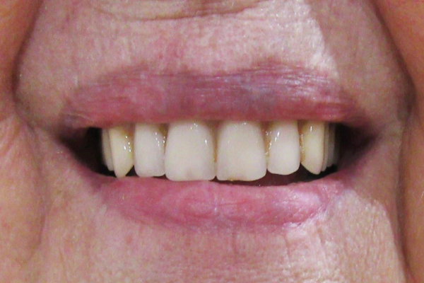 a close up of a man 's mouth with a beard and white teeth | Before and After Denture Treatment | Envision Denture and Implant Centre | Best Denturist In Surrey, British Columbia