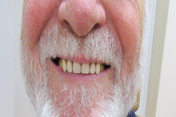 a close up of a woman 's mouth with white teeth and pink lipstick | Before and After Denture Treatment | Envision Denture and Implant Centre | Best Denturist In Surrey, British Columbia