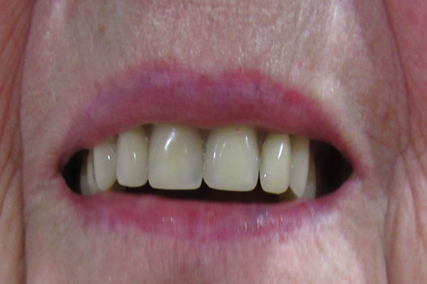 a close up of a person 's mouth with white teeth | Before and After Denture Treatment | Envision Denture and Implant Centre | Best Denturist In Surrey, British Columbia