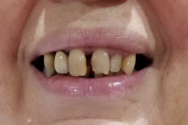 a close up of a man 's mouth with a missing tooth | Before and After Denture Treatment | Envision Denture and Implant Centre | Best Denturist In Surrey, British Columbia