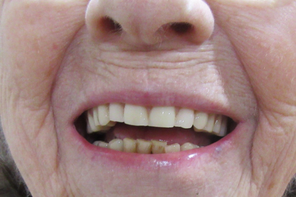 a close up of a person 's mouth with white teeth | Before and After Denture Treatment | Envision Denture and Implant Centre | Best Denturist In Surrey, British Columbia