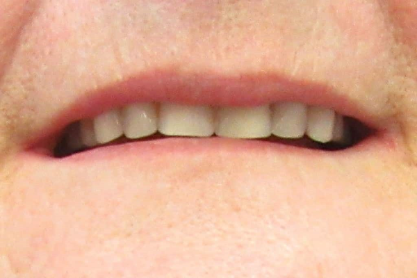 a close up of a man 's mouth with a missing tooth | Before and After Denture Treatment | Envision Denture and Implant Centre | Best Denturist In Surrey, British Columbia