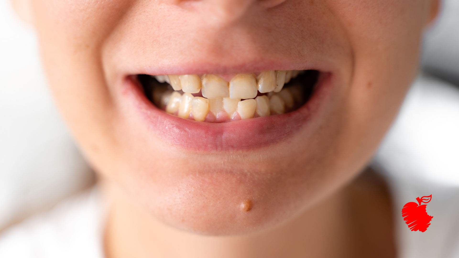 A close up of a woman 's mouth with a missing tooth.