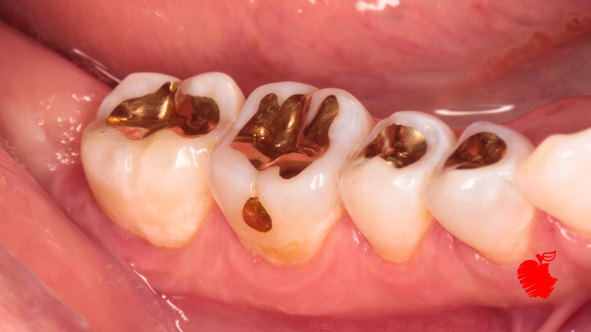 A close up of a person 's teeth with gold fillings.