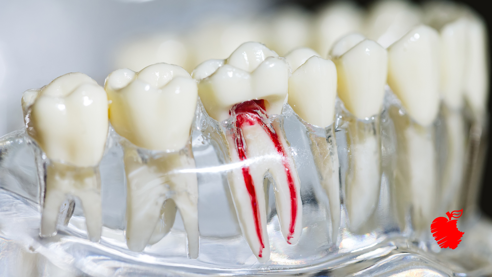 A model of a tooth with a hole in it.