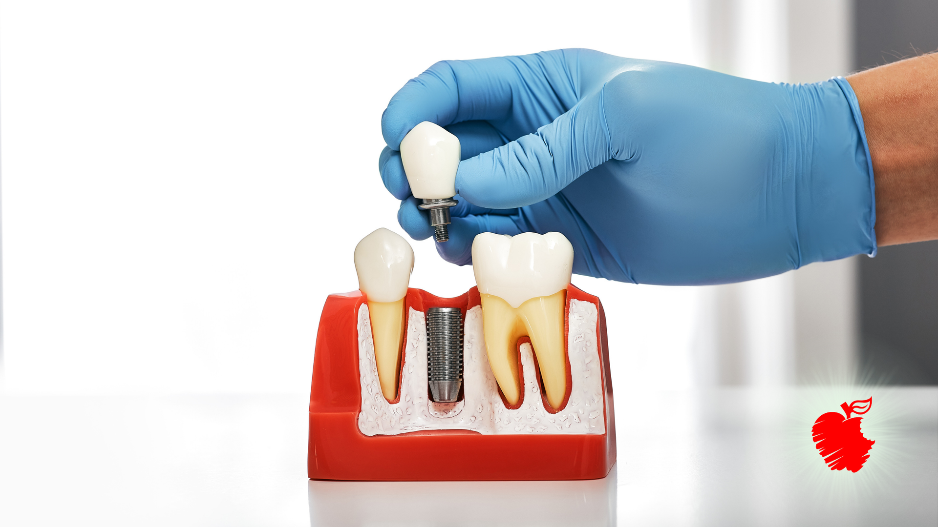 A gloved hand placing a dental crown on a model showing tooth implant next to a natural tooth.
