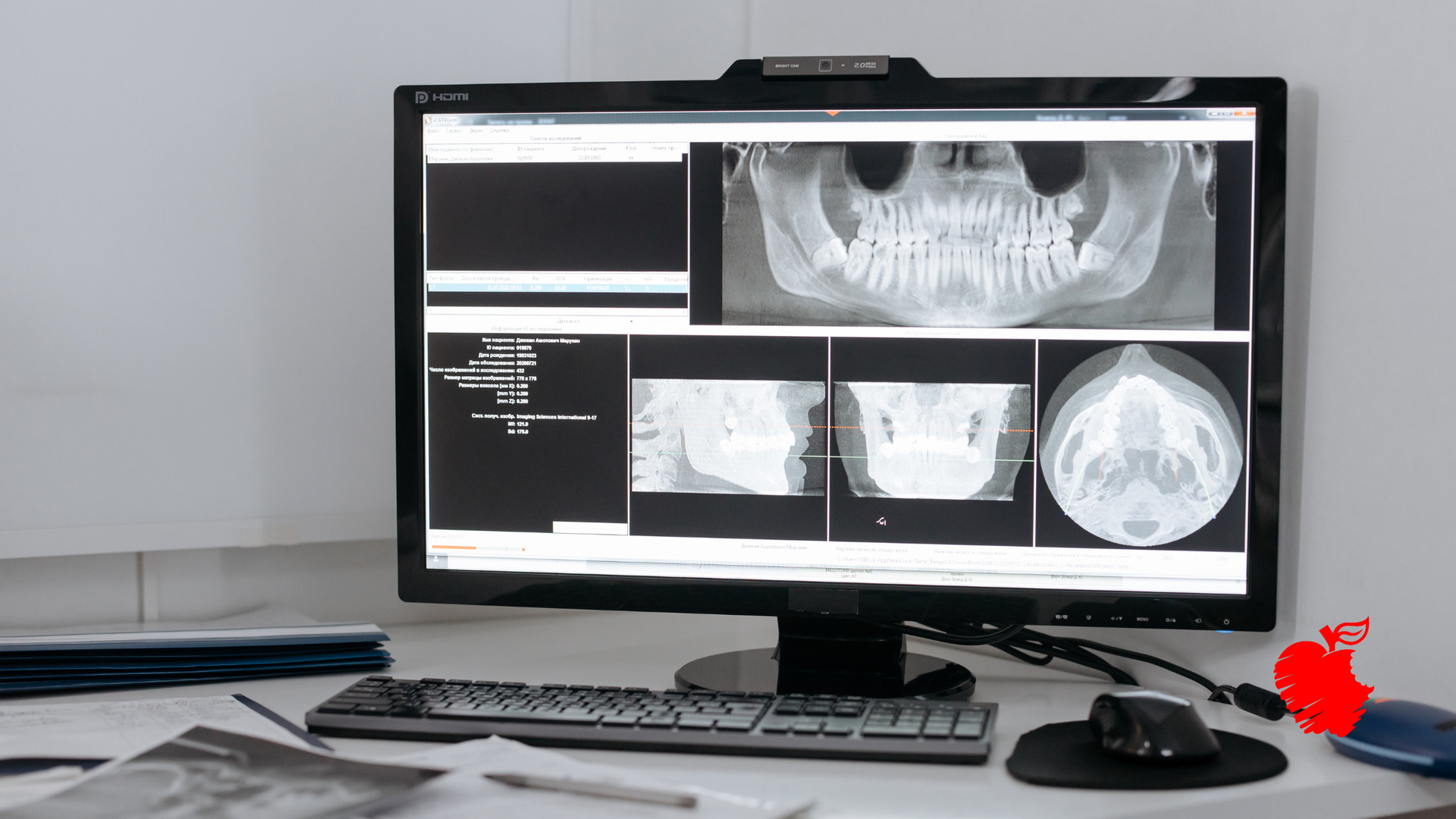 A computer monitor is displaying an x-ray of a person 's teeth.