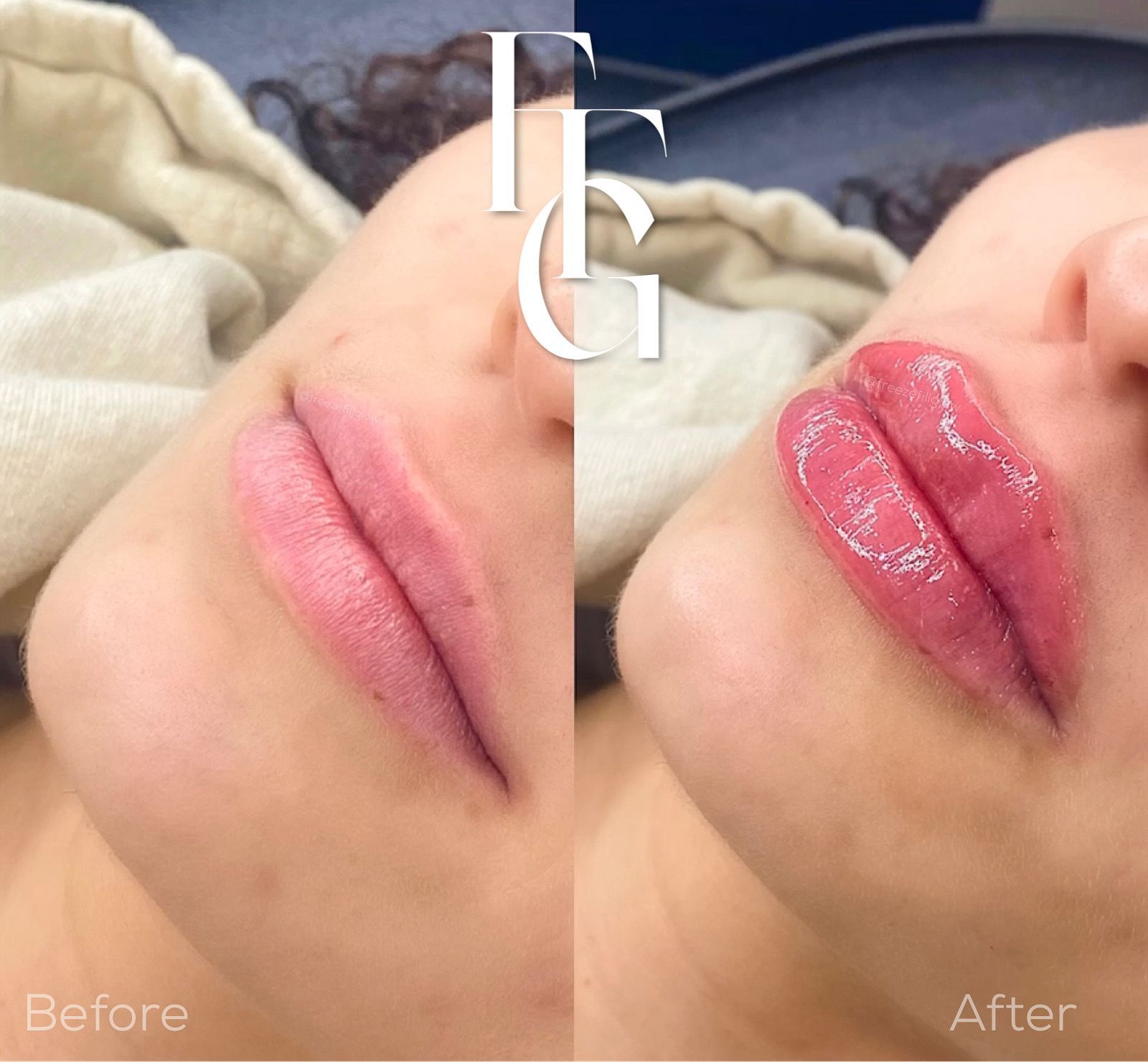 Dermal Fillers before and after image