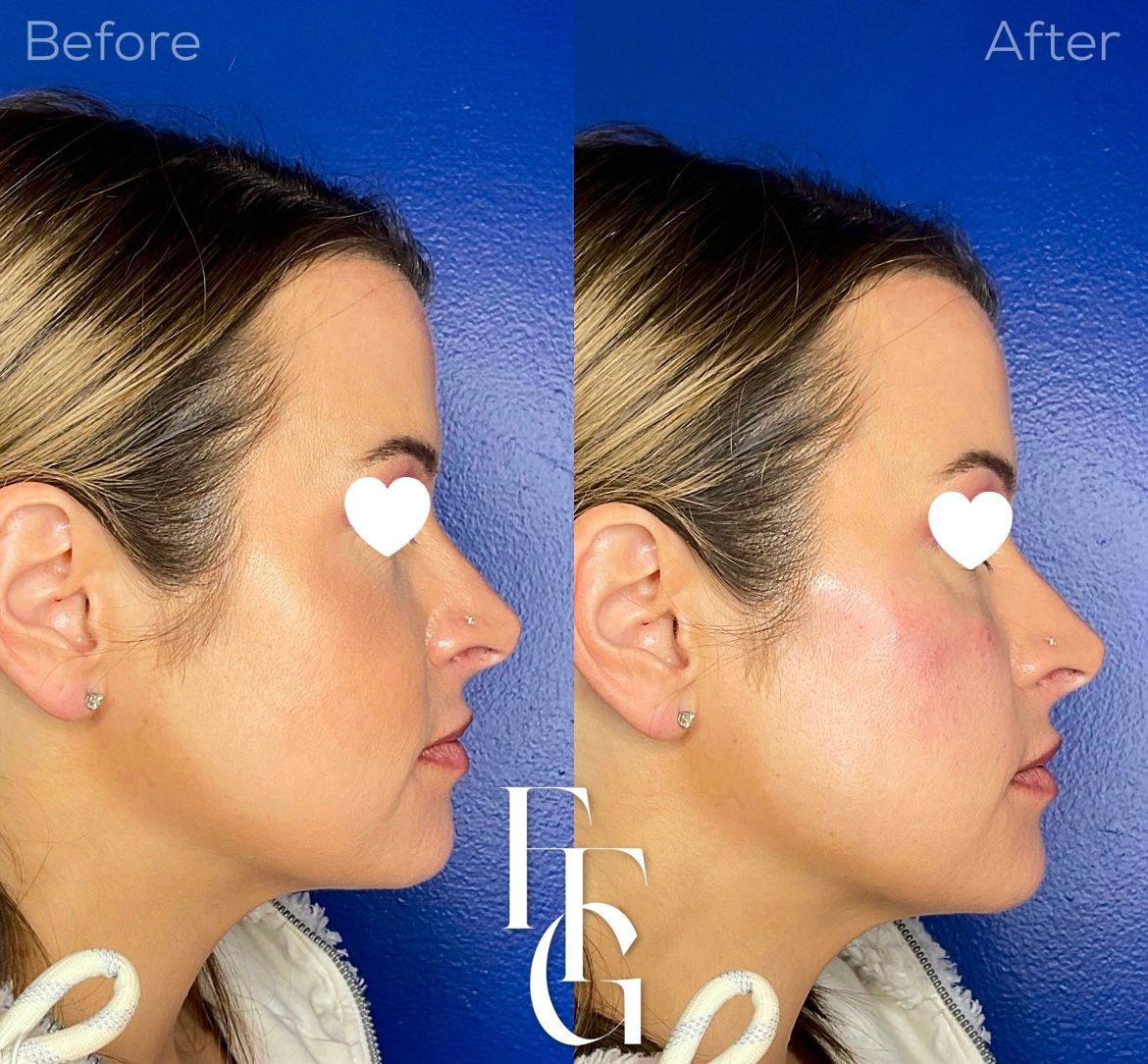 Dermal Fillers before and after image