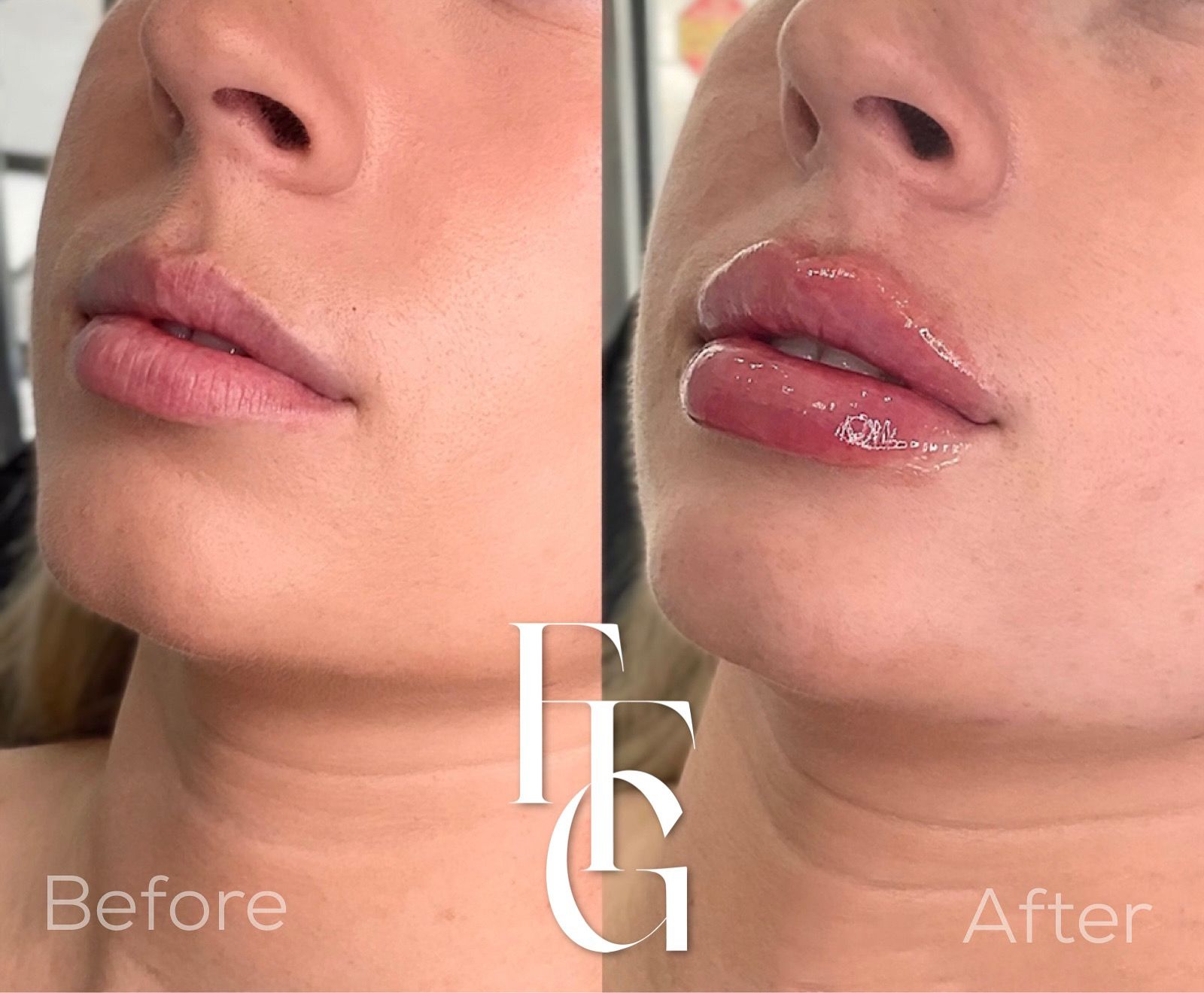 Dermal Fillers before and after image