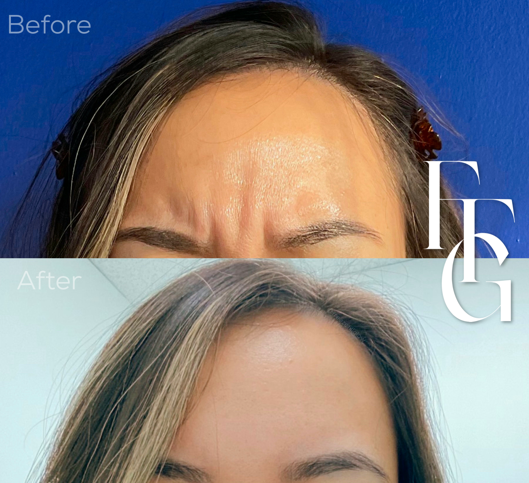 Botox Before and After Image