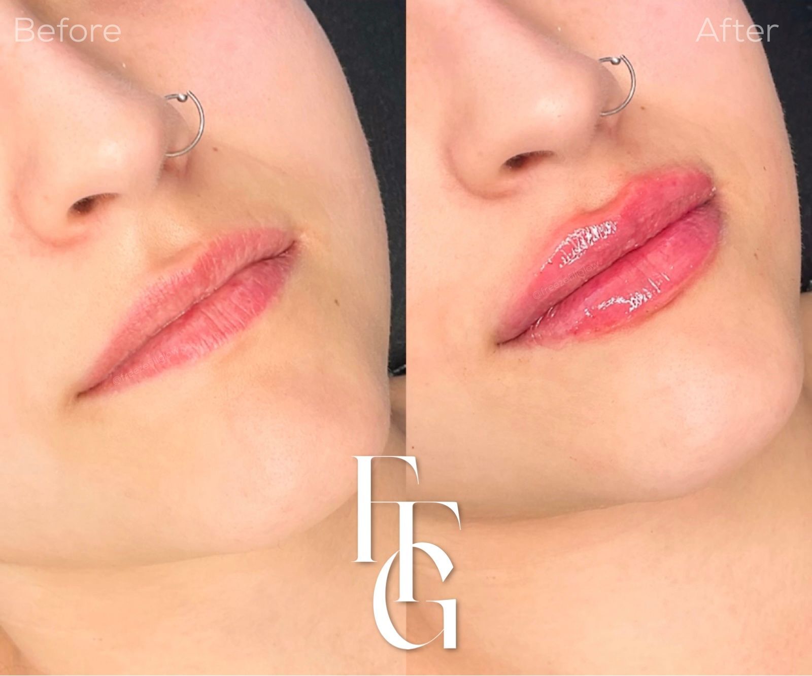 Dermal Fillers before and after image