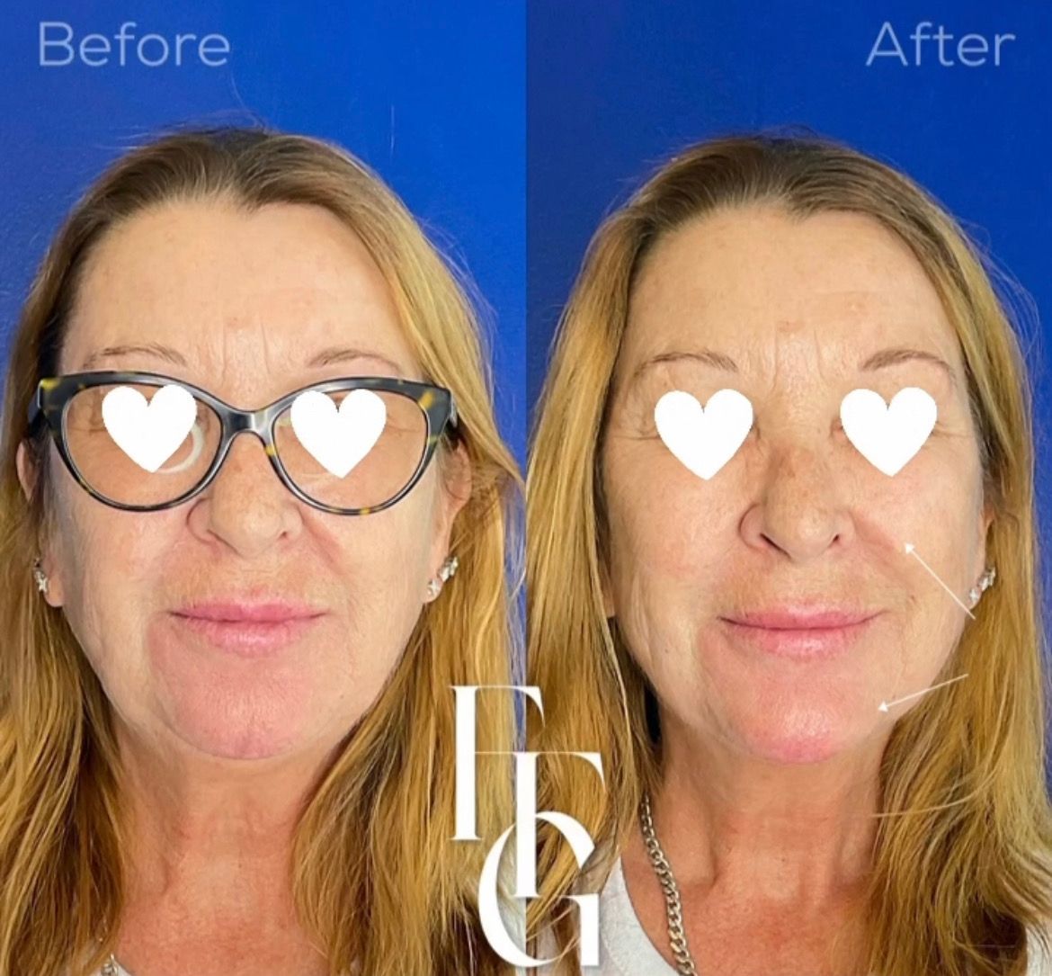 Dermal Fillers before and after image