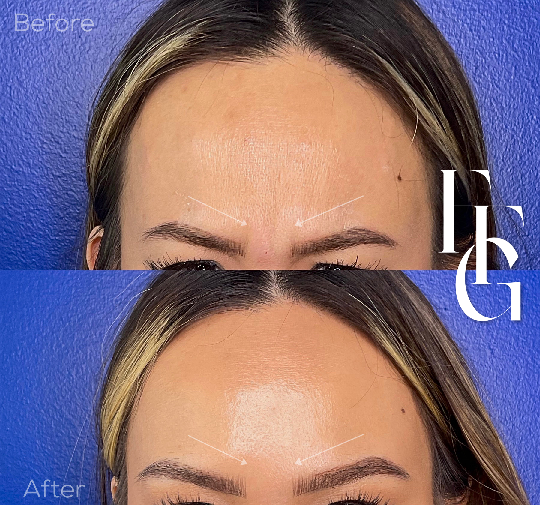 Botox Before and After Image