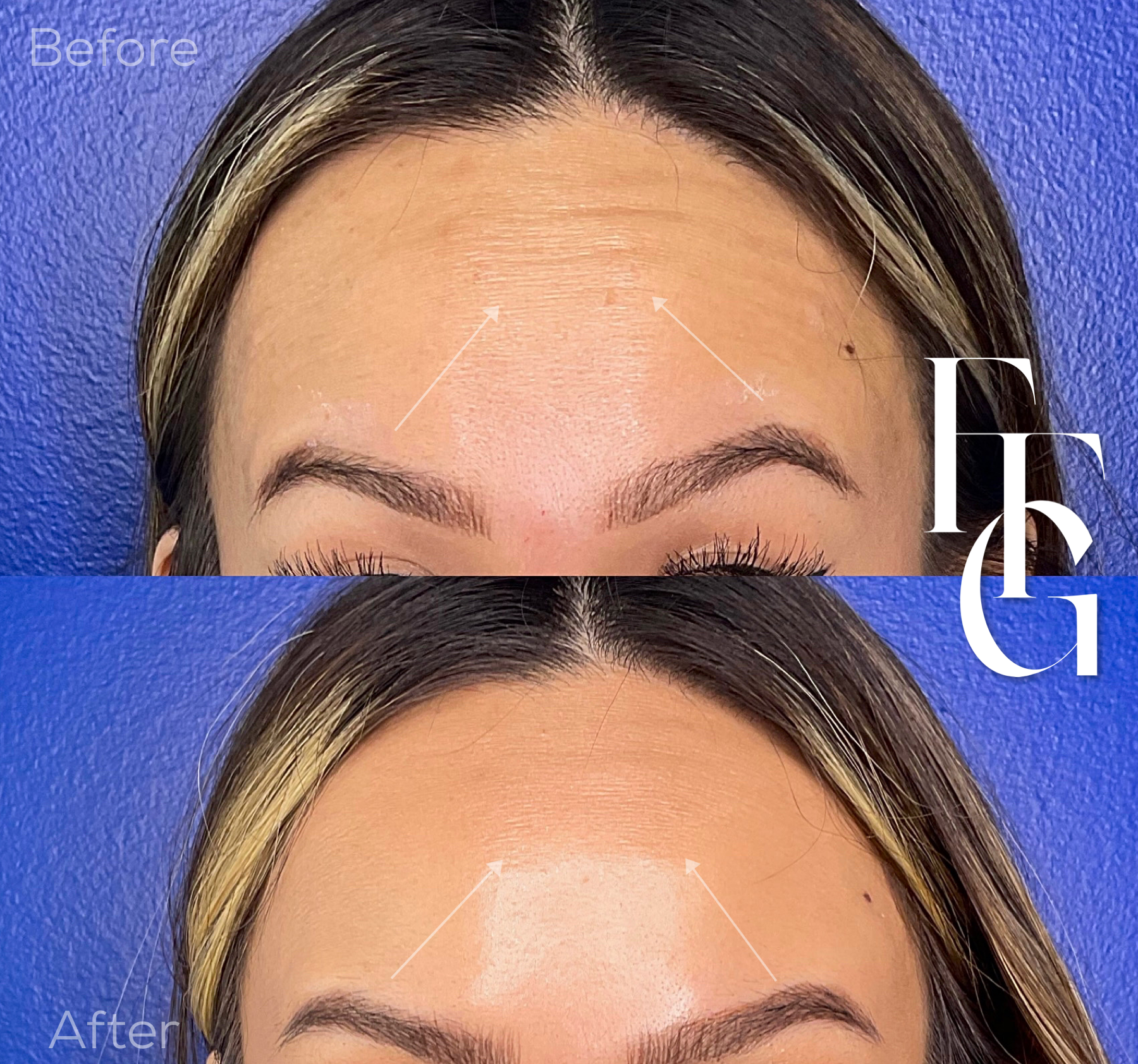 Botox Before and After Image