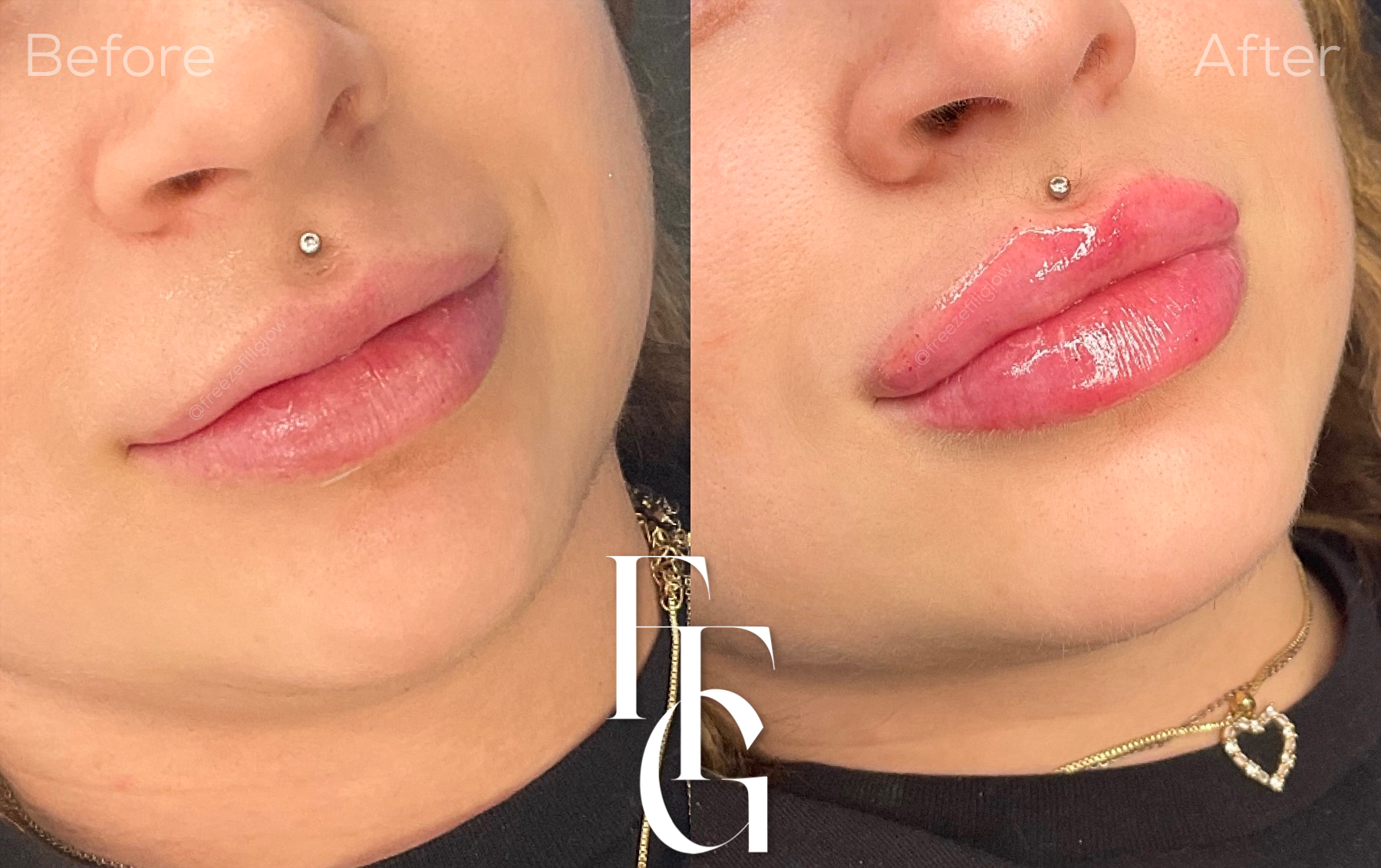 Dermal Fillers before and after image