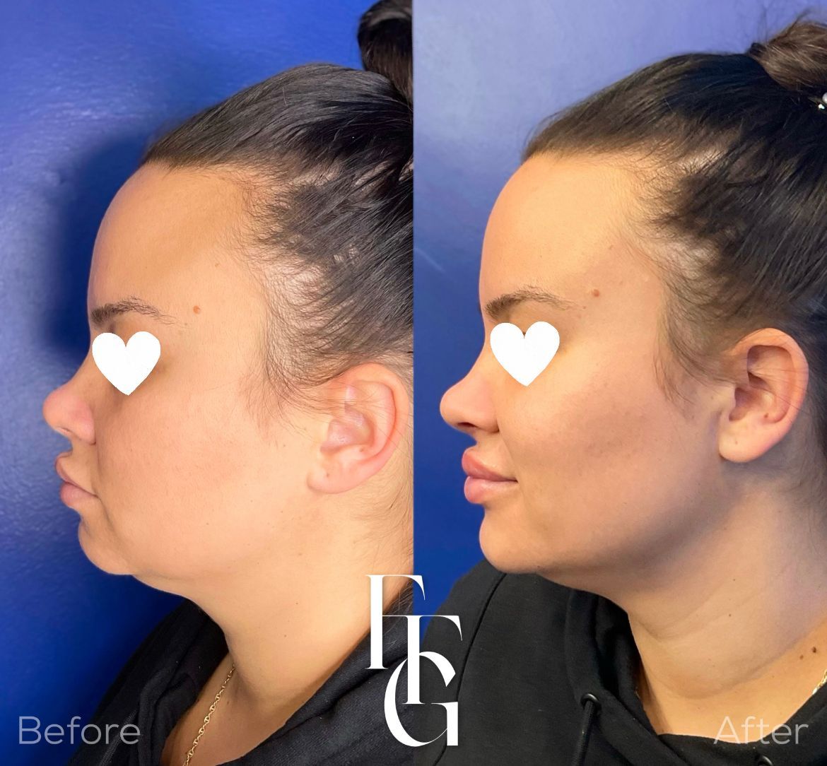 Dermal Fillers before and after image