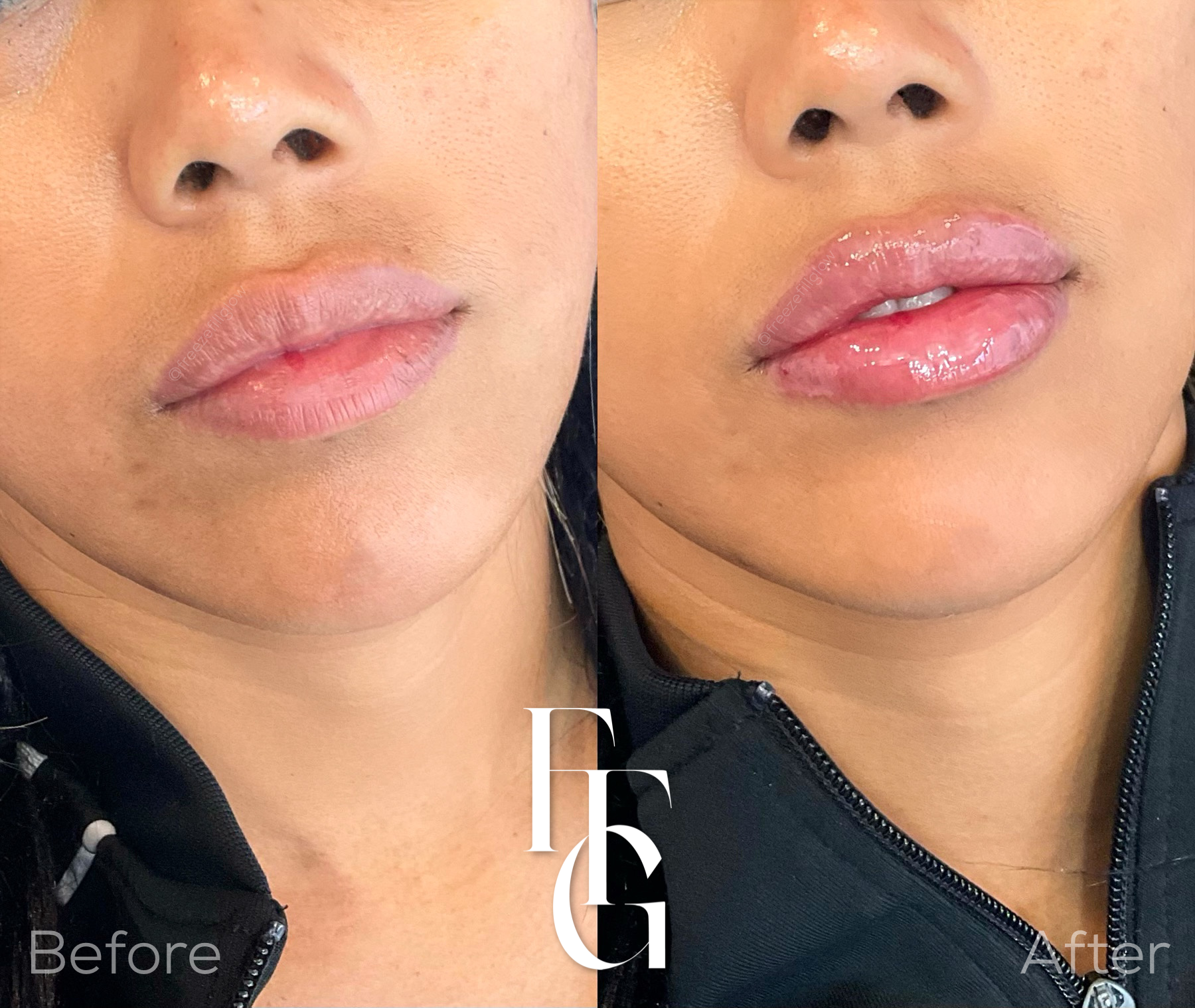 Dermal Fillers before and after image