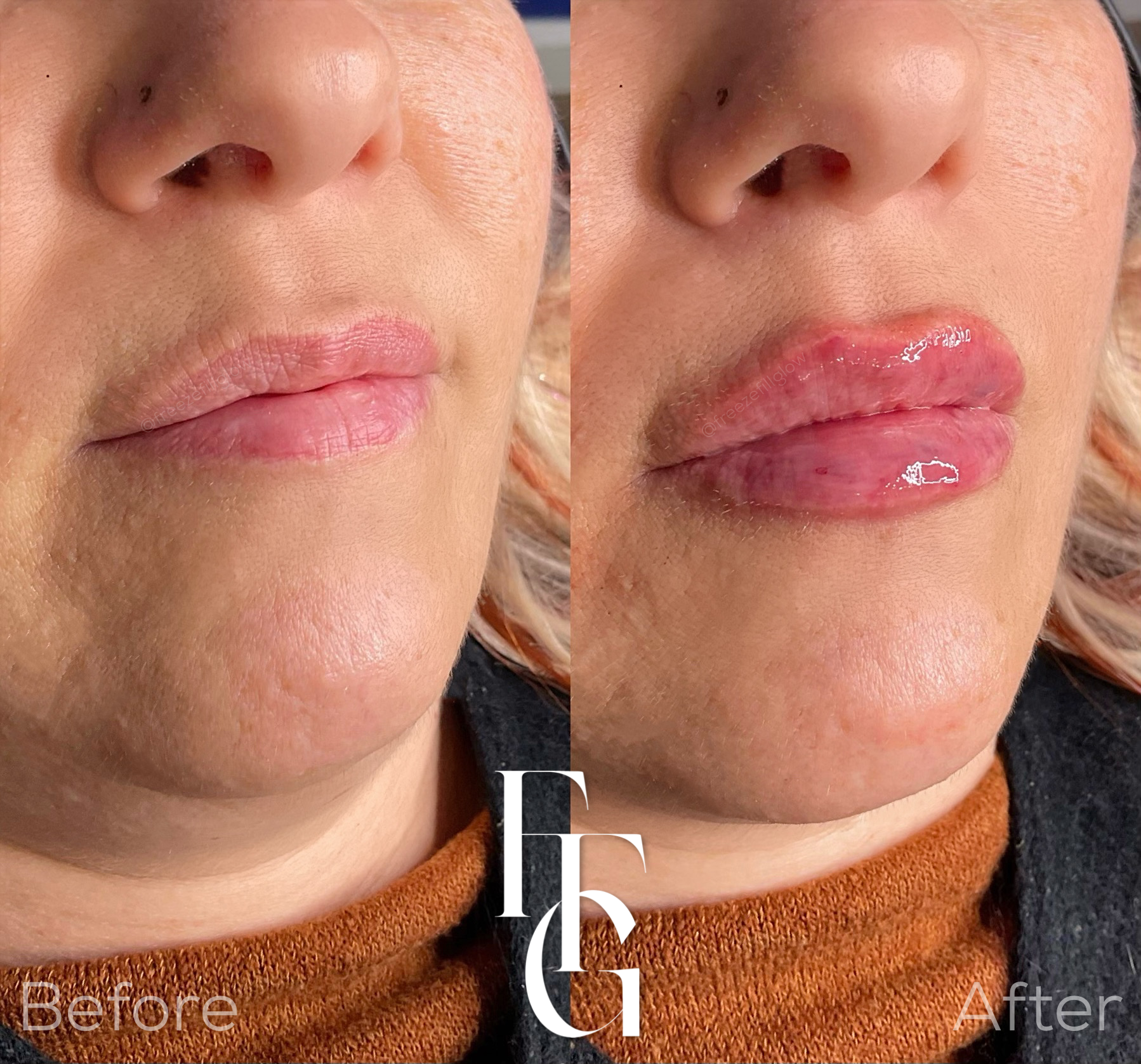 Dermal Fillers before and after image