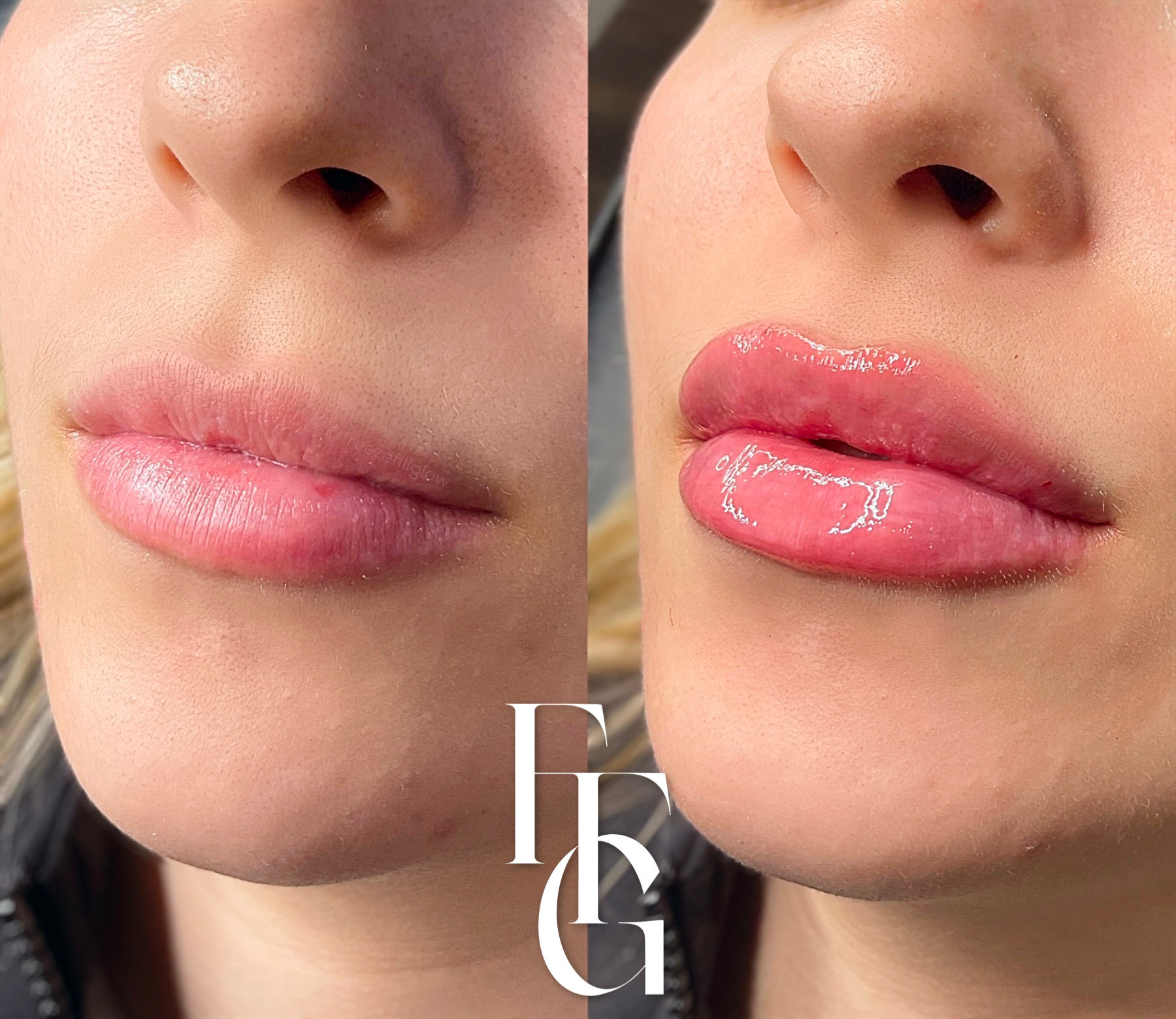 Dermal Fillers before and after image