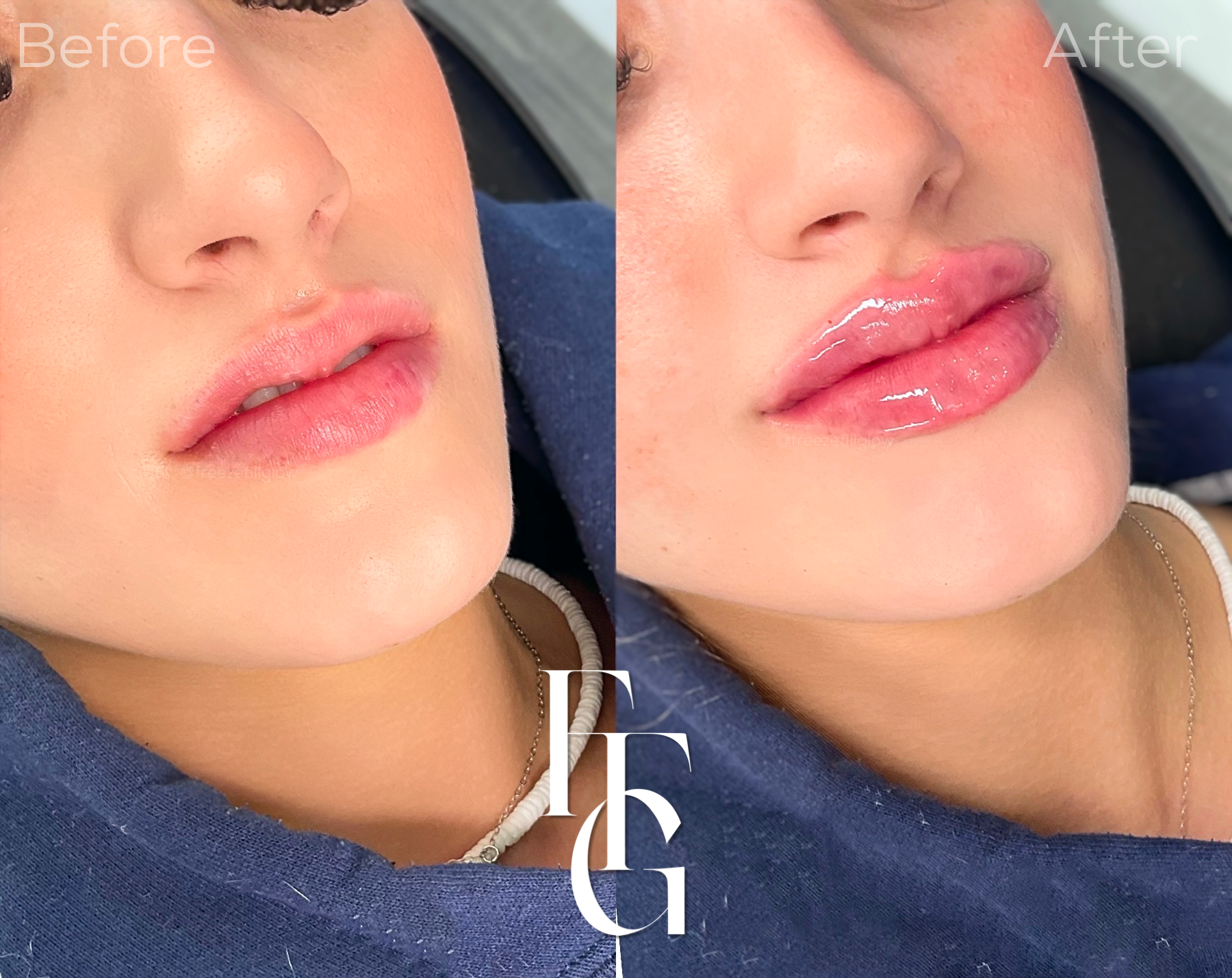 Dermal Fillers before and after image