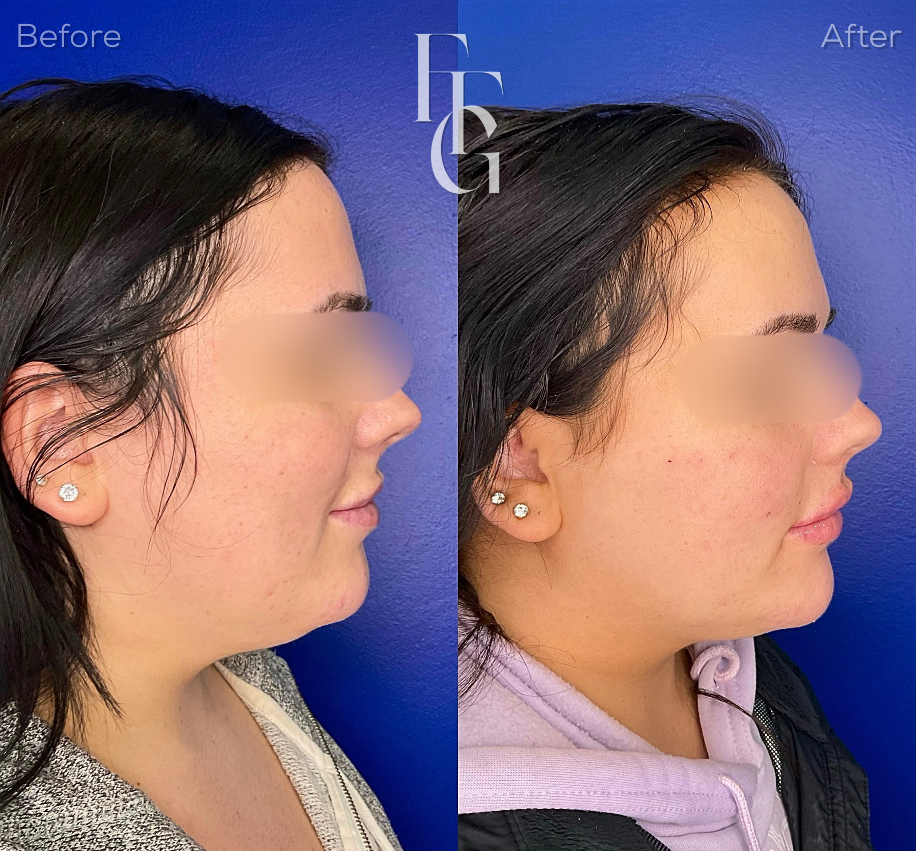 Dermal Fillers before and after image