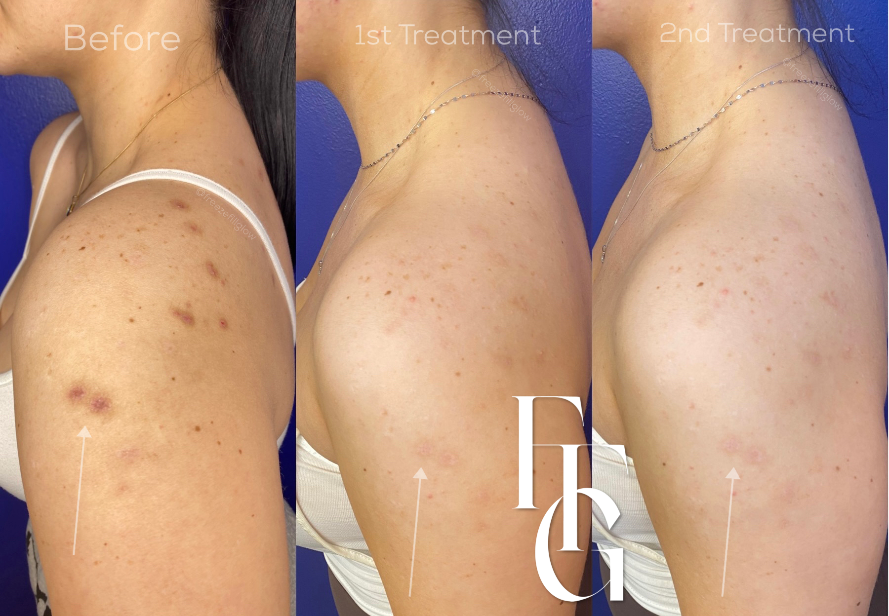 PRP Before and after image