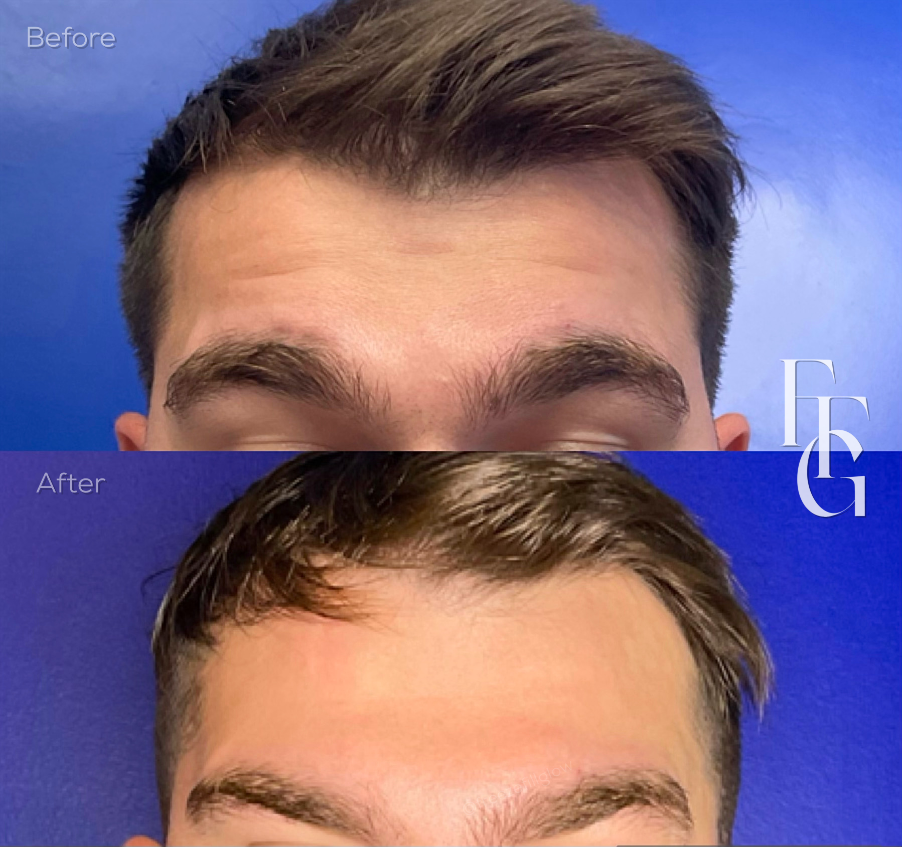 Botox Before and After Image