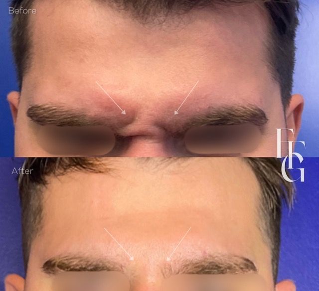 Botox Before and After Image