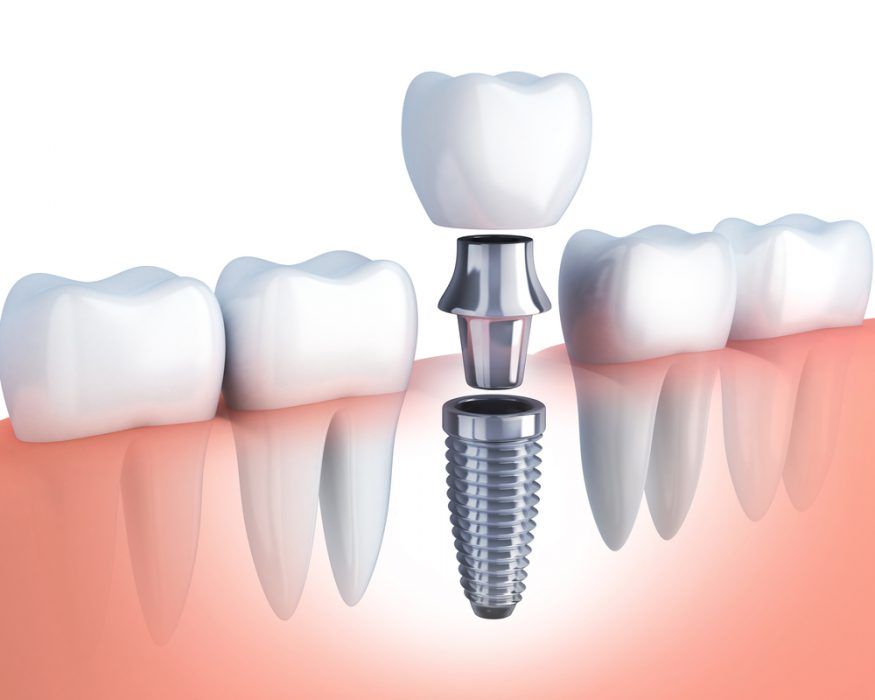 strumenti per interventi di chirurgia dentale