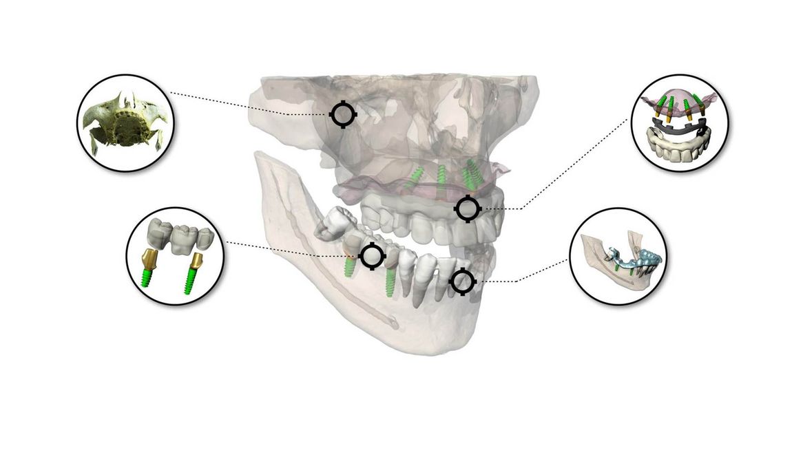 software 3D per pianificazione di impianti dentali